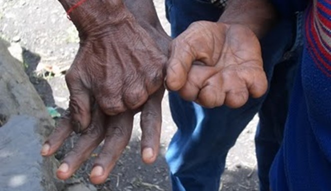 Tradisi Potong Jari Di Papua. Tradisi Potong Jari di Papua, Sebuah Simbol Kesetian yang Mendalam